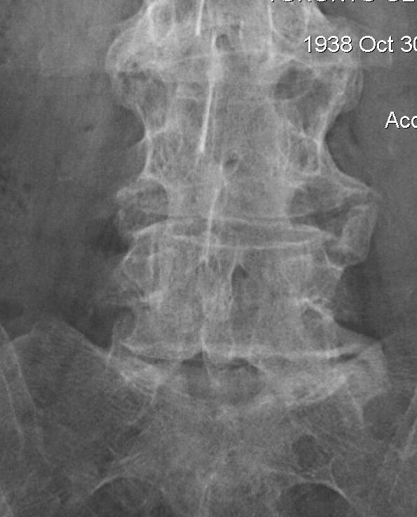 Ankylosing Spondylitis